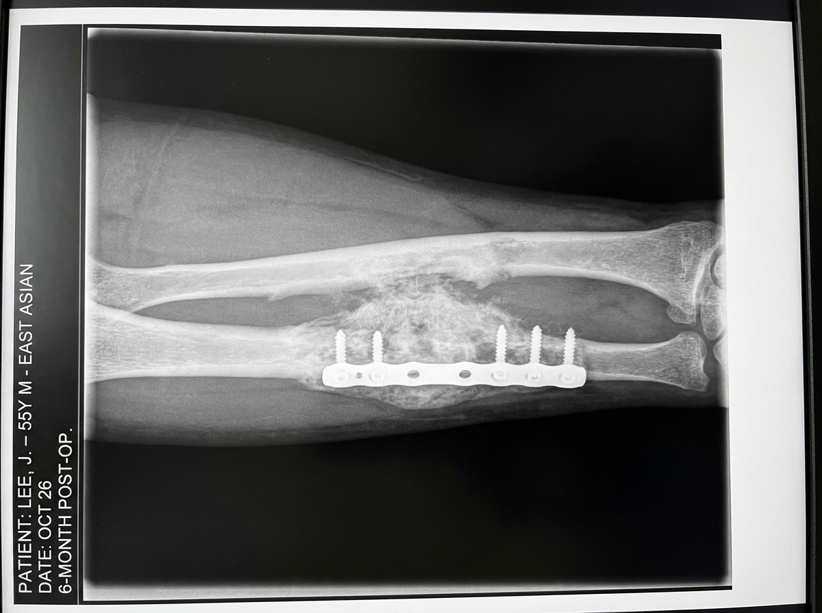 bone-graft-implant gallery 3